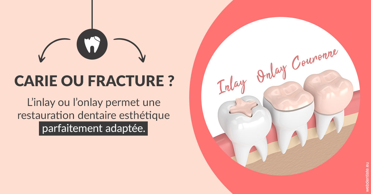 https://dr-kuetche-regille.chirurgiens-dentistes.fr/T2 2023 - Carie ou fracture 2