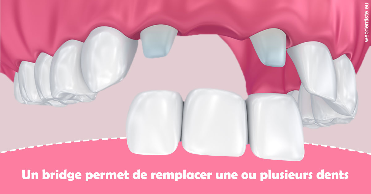 https://dr-kuetche-regille.chirurgiens-dentistes.fr/Bridge remplacer dents 2