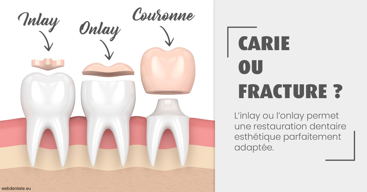 https://dr-kuetche-regille.chirurgiens-dentistes.fr/T2 2023 - Carie ou fracture 1