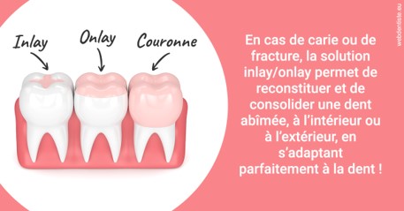 https://dr-kuetche-regille.chirurgiens-dentistes.fr/L'INLAY ou l'ONLAY 2