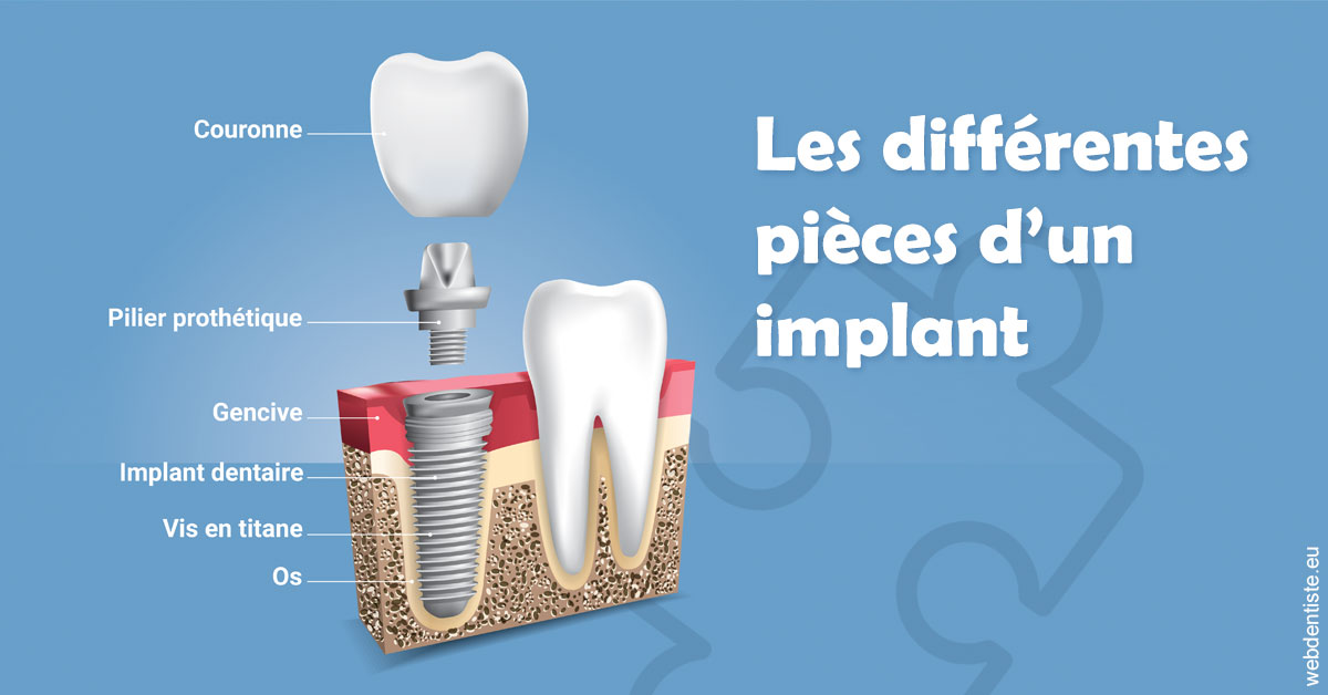 https://dr-kuetche-regille.chirurgiens-dentistes.fr/Les différentes pièces d’un implant 1